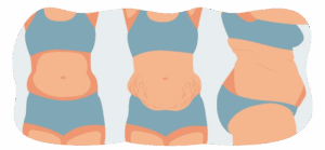 Dr. Demetris Stavrou and the European Institute of Plastic Surgery in Limassol Announce Upcoming Launch of Advanced Tummy Tuck 360 Procedure