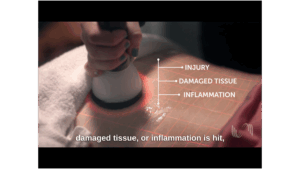 New Treatment in Western PA for Healing Neuropathy While Also Controlling Pain