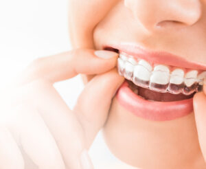 Invisalign Clear Aligners Congleton Cheshire Teeth Straightening Consultations Announced at Crown Bank Dental
