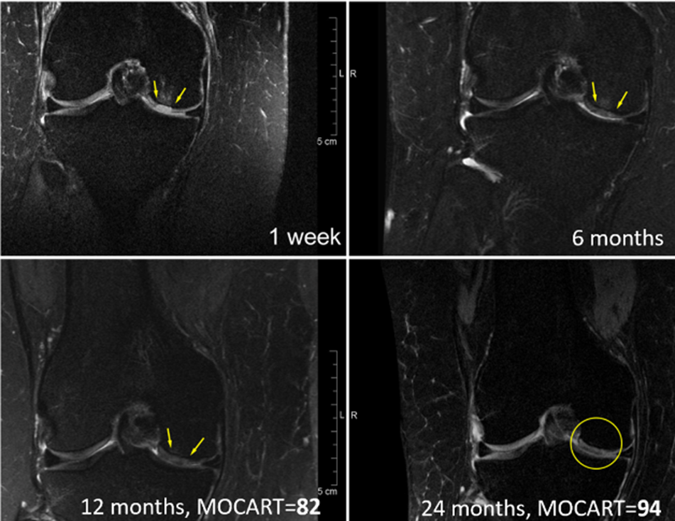 Regentis’ GelrinC Demonstrates Breakthrough in Regenerating Native-Like Cartilage Structure in Knee Repair on MRI Results Confirmed Using a Validated, Regulator-Accepted Method