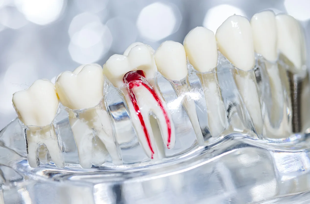 Root Canal Treatment Kidbrooke General Dental Consultation Availability Announced at Kidbrooke Village Dentist (Smile 4 U)