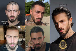 10 Factors Patients Consider When Choosing a Hair Transplant Clinic in Turkey